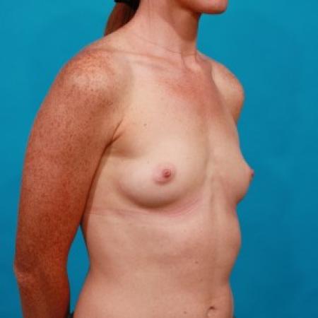 Before image 2 Case #84041 - Silicone Breast Augmentation