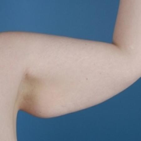 Before image 1 Case #79016 - Arm Lift