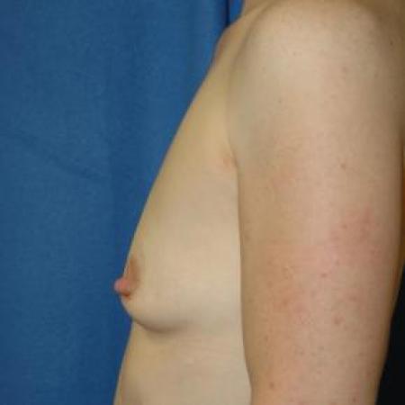 Before image 3 Case #80886 - Breast Augmentation 