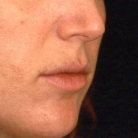 Before Case #81641 - Lip Augmentation