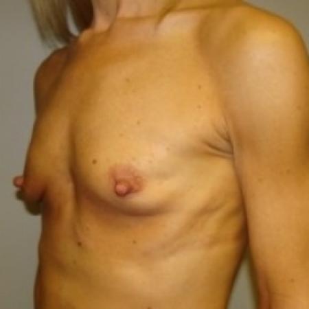 Before image 2 Case #79396 - Breast Augmentation