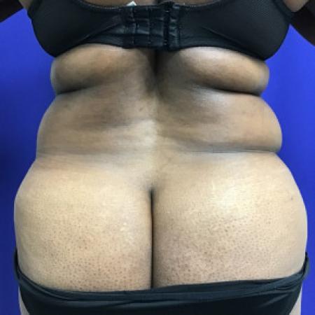 Before image 4 Case #88281 - Tummy Tuck and Liposuction