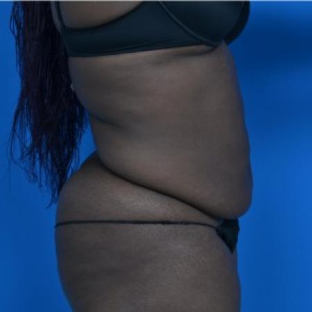 Before image 2 Case #87871 - Tummy Tuck