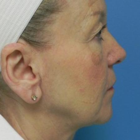 Before image 3 Case #86616 - Facelift/Upper & Lower Blepharoplasty/Laser Resurfacing to Full Face/Juvederm      7 months post-op