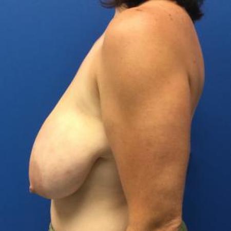 Before image 2 Case #88431 - Breast lift on a 32 year old female