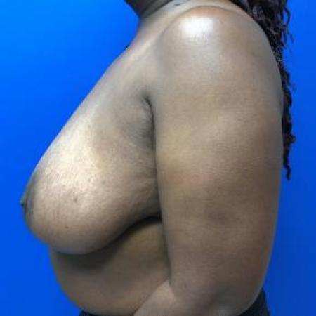 Before image 2 Case #88266 - Breast reduction on a 47 year old female