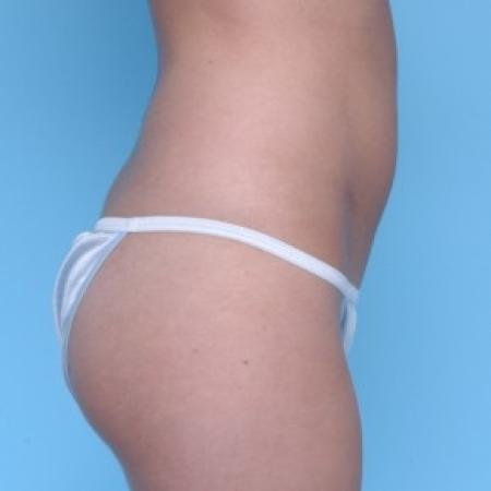 Before image 2 Case #82291 - Liposuction