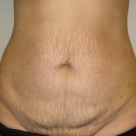 Before image 1 Case #79481 - Tummy Tuck