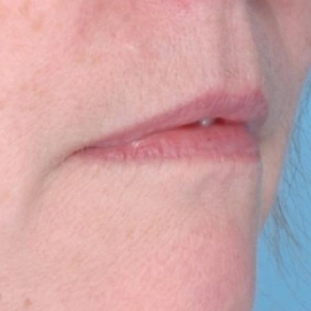 Before image 2 Case #79286 - Injectables