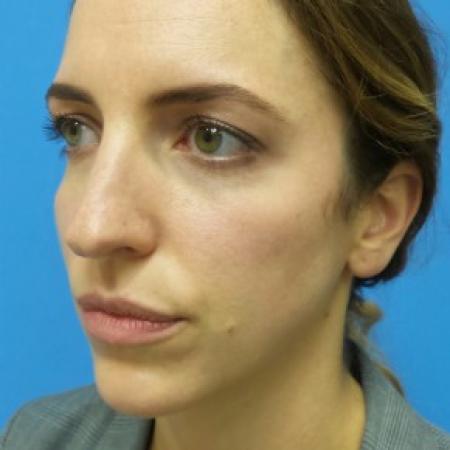 Before image 2 Case #87411 - 31 year-old  -  Open Rhinoplasty/Endoscopic Browlift  -  3 months post-op