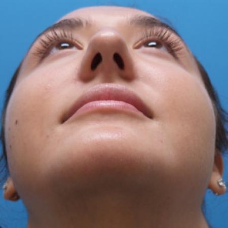 Before image 4 Case #88381 - 21 year-old  -  Rhinoplasty  -  4 months post-op