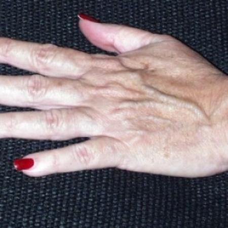 Before image 1 Case #79786 - Fat Transfer Hand Rejuvenation