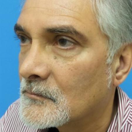 Before image 2 Case #87361 - 62 year-old  -  Secondary Rhinoplasty with Cartilage Grafting  - 1 year post-op