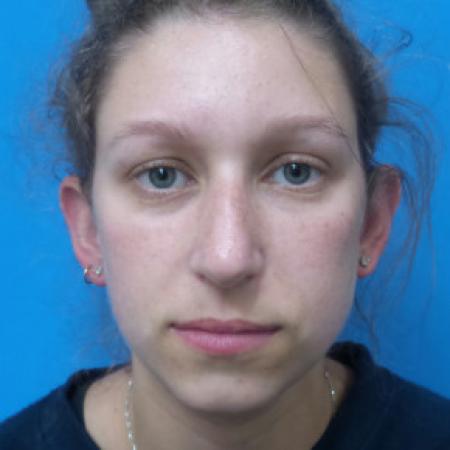 Before image 1 Case #88391 - 25 year old  -  Rhinoplasty/Septoplasty/Partial Turbinectomy  -  7 months post-op