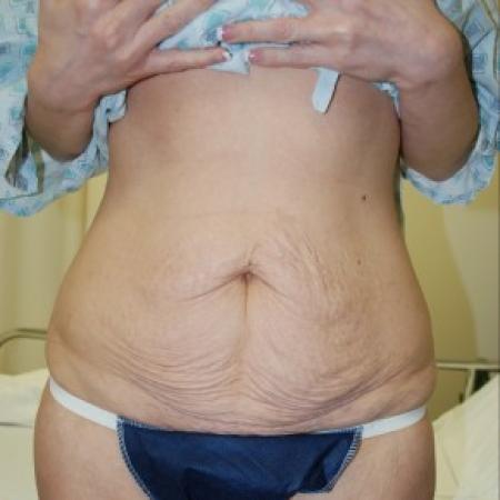 Before image 1 Case #85811 - Traditional abdominoplasty after children
