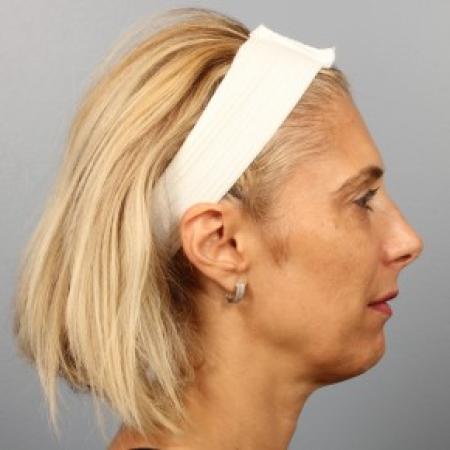Before image 2 Case #87416 - Full facial rejuvenation with Fat Injections