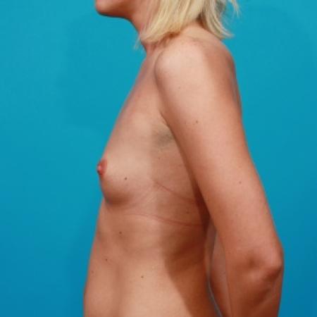 Before image 3 Case #79591 - Silicone Breast Augmentation