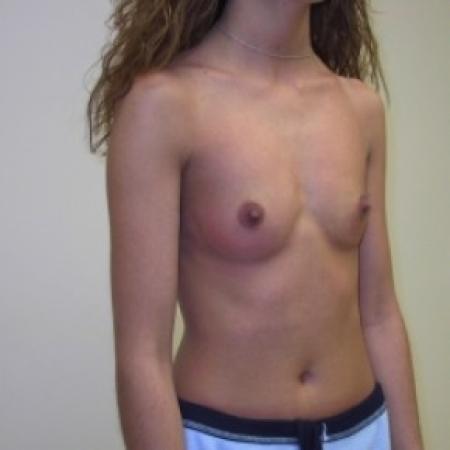 Before image 2 Case #81236 - Bilateral breast augmentation with saline filled implants 