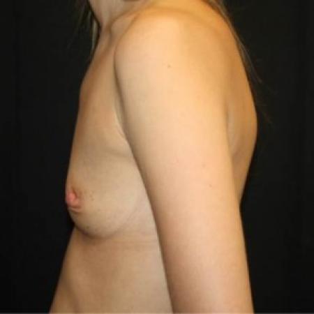 Before image 3 Case #84926 - Breast Augmentation - 33 year old female
