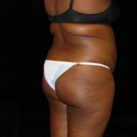 Before image 4 Case #80486 - Buttocks Augmentation Via Fat Grafting with Liposuction of Abdomen, Waist, Flanks, and Dorsal Roll