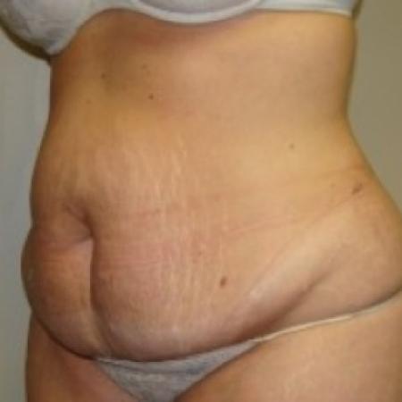 Before image 2 Case #79471 - Tummy Tuck