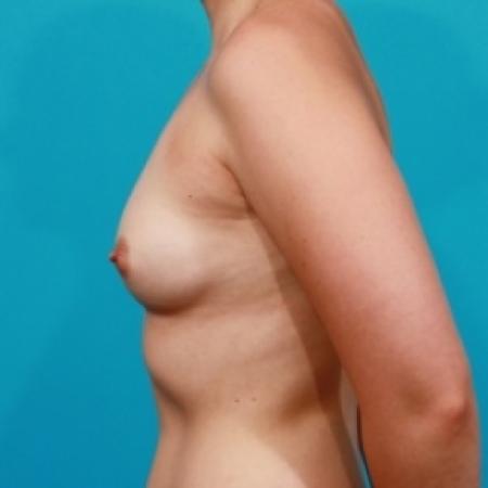 Before image 3 Case #78601 - Silicone Breast Implants