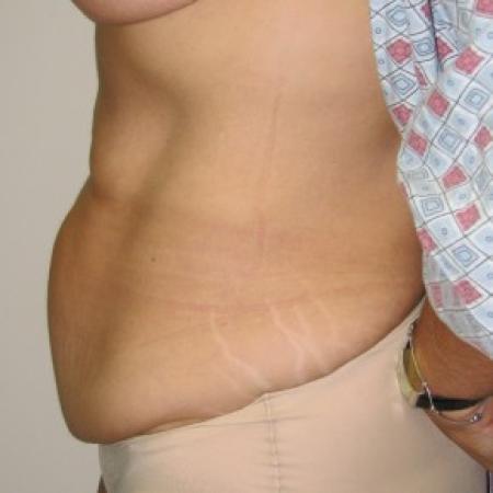 Before image 3 Case #85806 - Massive weight loss patient with Fleur-de-Lis abdominoplasty
