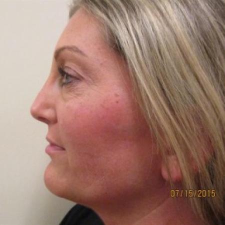 Before image 2 Case #82716 - Fat transfer to Face (39 years old)