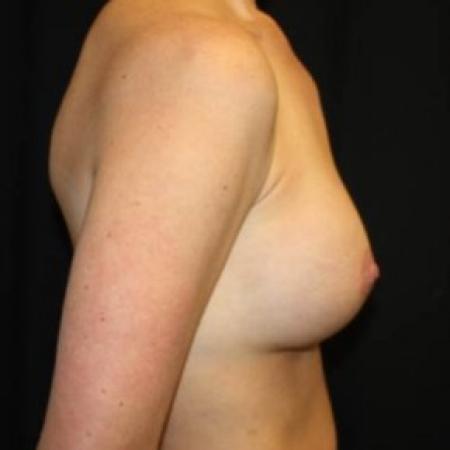 Before image 3 Case #84871 - Breast Implant Exchange - 37 year old female