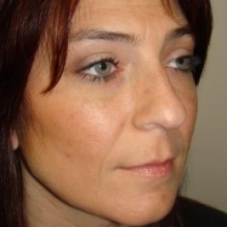 Before image 3 Case #79556 - Rhinoplasty