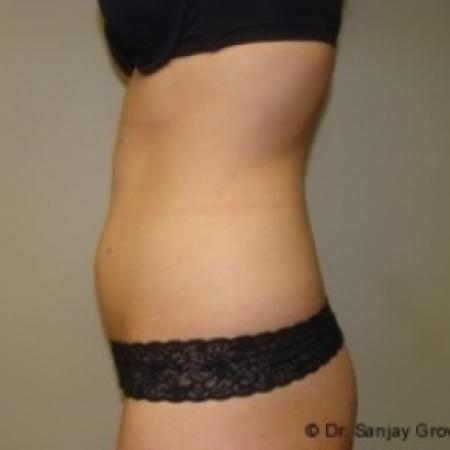Before image 3 Case #79031 - Liposuction