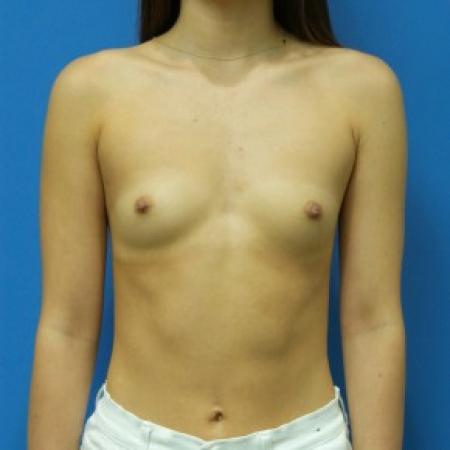 Before image 1 Case #87116 - 22 year old - 295cc - High Cohesive - Shaped - silicone gel