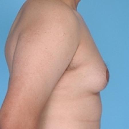 Before image 2 Case #79236 - Male Breast Reduction