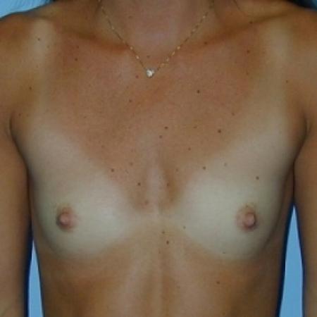 Before image 1 Case #79091 - Saline Breast Implants