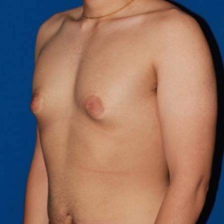 Before image 2 Case #79991 - Gynecomastia male breast reduction