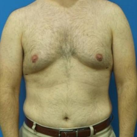 Before image 1 Case #87421 - 45 year-old  -  Liposuction to Chest with Renuvion (SkinTite) /Liposuction to Lateral Flanks - 4 months post-op