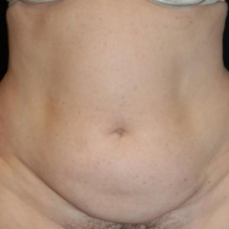 Before image 1 Case #79766 - Tummy Tuck & Lipo of Love Handles