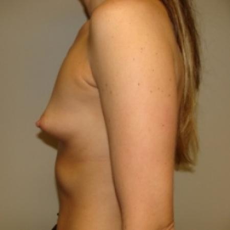 Before image 3 Case #79876 - BREAST AUGMENTATION
