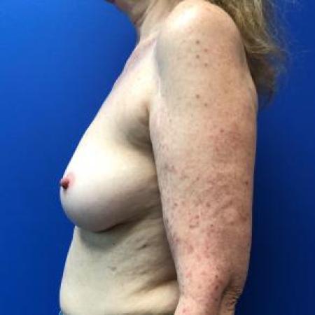 Before image 2 Case #88211 - Breast Reconstruction on a 63 year old female patient