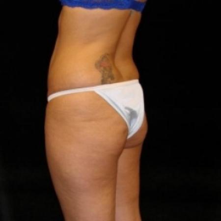 Before image 4 Case #80456 - Buttocks Augmentation Via Fat Grafting with Liposuction of Abdomen, Waist, Flanks, Outer Thighs, and Mini Tummy Tuck