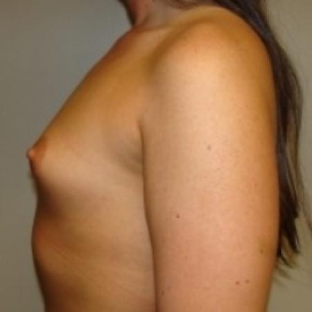 Before image 3 Case #79381 - Breast Augmentation