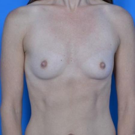 Before image 1 Case #87786 - Breast Augmentation with Natrelle Inspira 265cc SRF  silicone gel breast implants