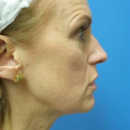 Before image 3 Case #87096 - 49 year old  -  Rhinoplasty/Septoplasty/Turbinectomy  -  3 months post-op