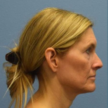 Before image 3 Case #86146 - Minimal Access Cranial Suspension (MACS) Lift