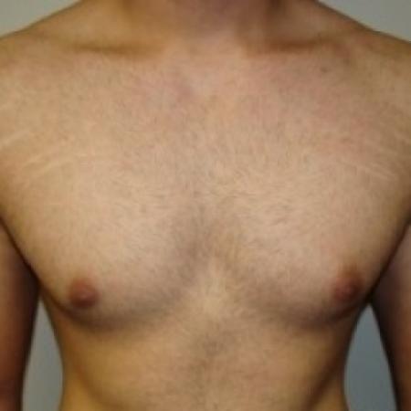 Before image 1 Case #79046 - Gynecomastia