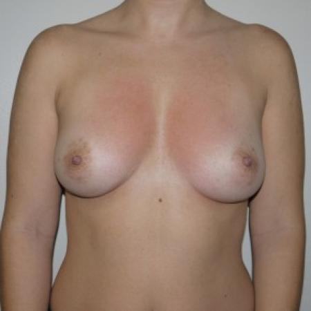 Before image 1 Case #82301 - Sub muscular Breast Augmentation