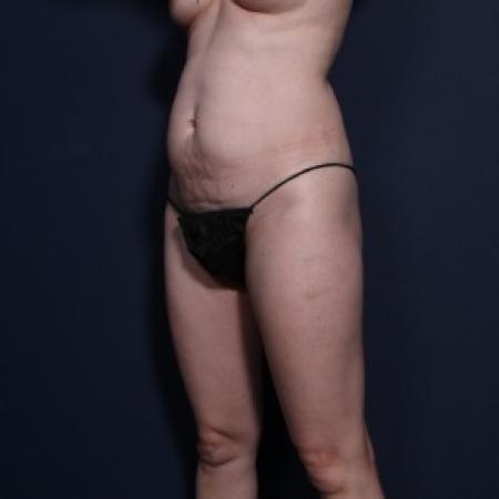 Before image 2 Case #85856 -  Abdominoplasty Post-Op 2 Months