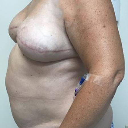Before image 2 Case #87326 - Breast Reconstruction Revision