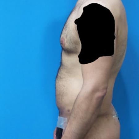 Before Case #88451 - Circumferential Body Lift /Gynecomastia Reduction