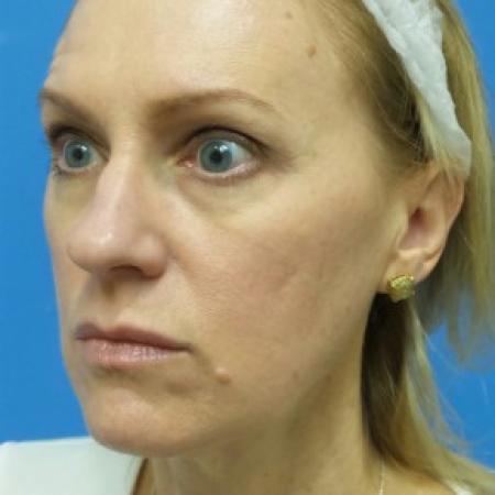 Before image 2 Case #87096 - 49 year old  -  Rhinoplasty/Septoplasty/Turbinectomy  -  3 months post-op